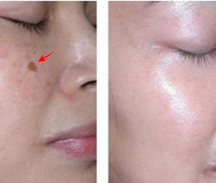 Original Arbi Girl Cream 20ml - Natural Solution for Acne, Blemishes & Anti-Freeze Protection